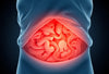 Voorkom de terugkeer van een hernia: wat je moet weten en doen