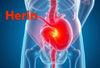 De stille pijn van een hernia: herken de signalen en vind verlichting